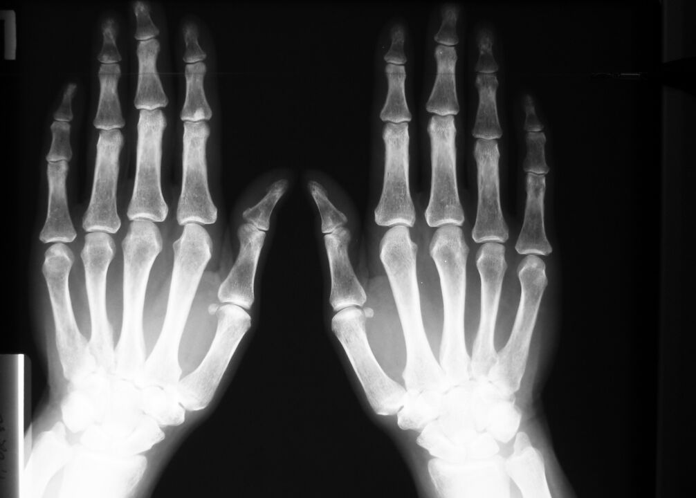 rentgenstūris, lai diagnosticētu sāpes pirkstu locītavās